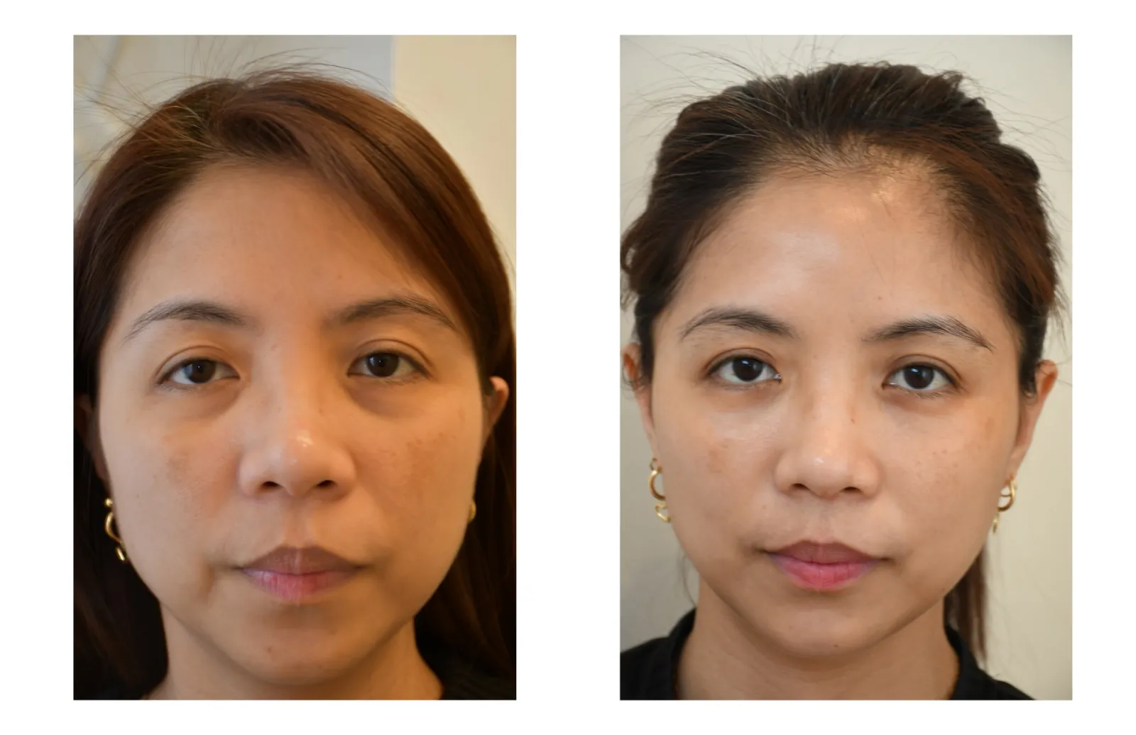 Additional before and after facial treatment case image provided by Azabu Skin Clinic