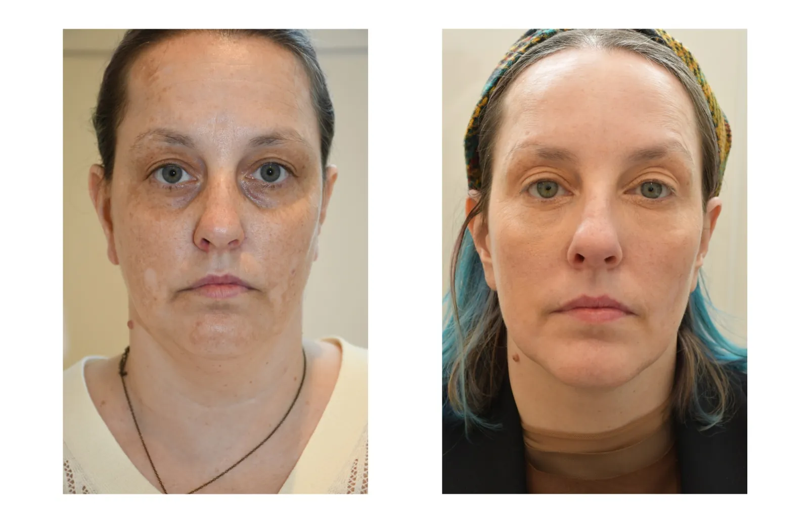 Additional before and after facial treatment case image provided by Azabu Skin Clinic
