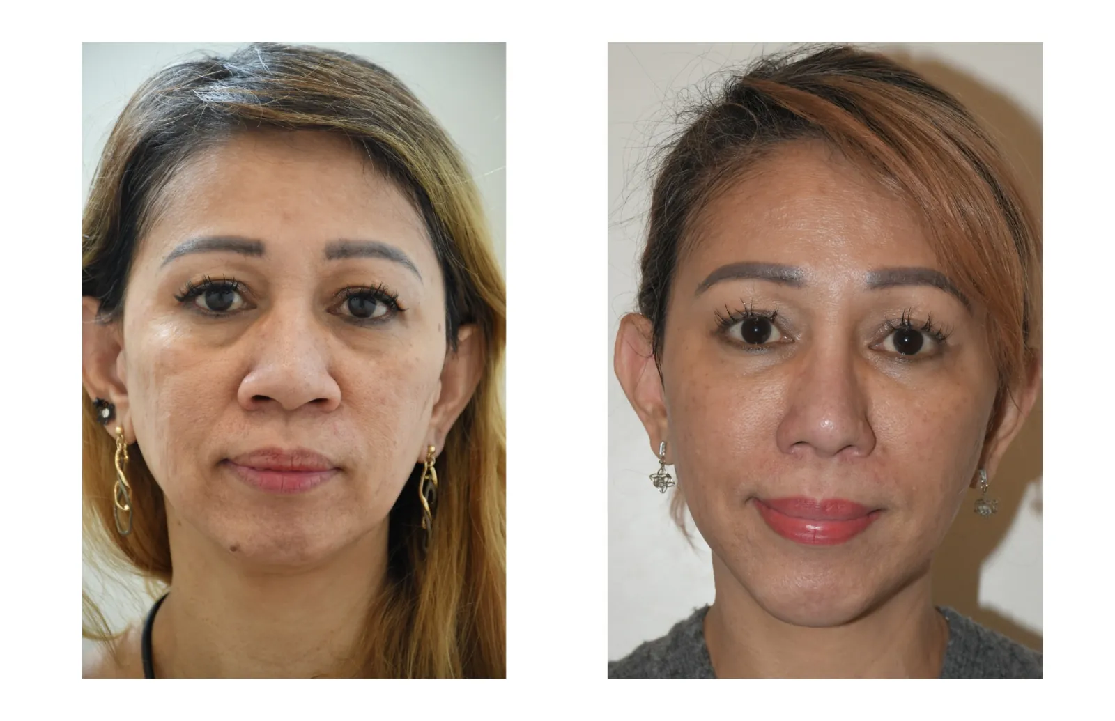 Additional before and after facial treatment case image provided by Azabu Skin Clinic