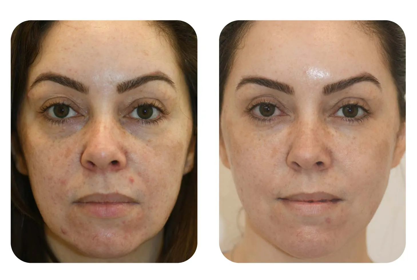 Additional before and after facial treatment case image provided by Azabu Skin Clinic