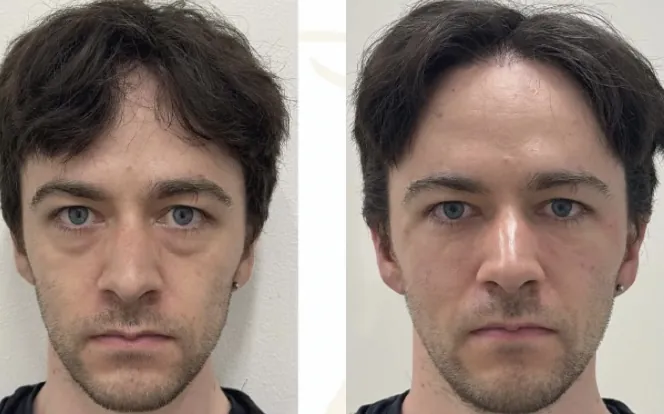 Additional before and after facial treatment case image provided by Azabu Skin Clinic