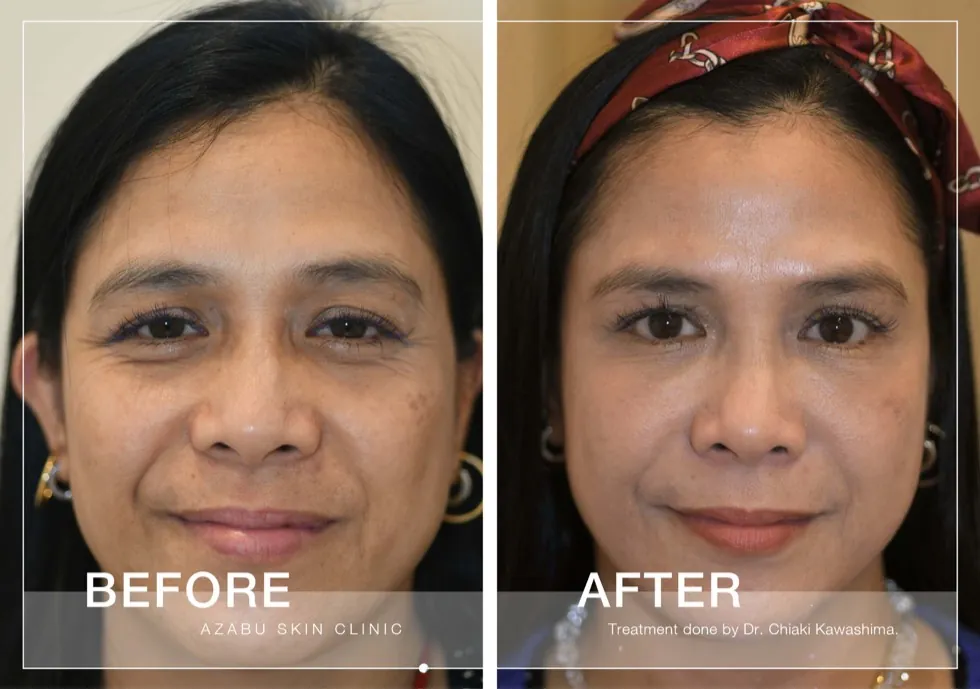 Before and after skin tightening treatment case from Azabu Skin Clinic
