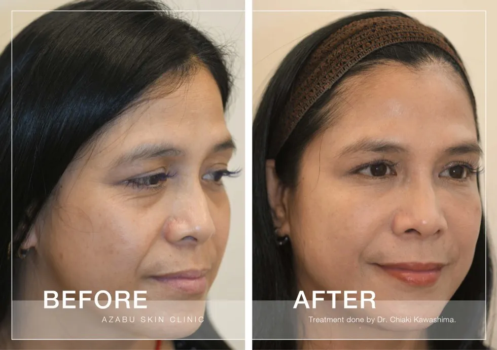 Before and after facial rejuvenation treatment case from Azabu Skin Clinic
