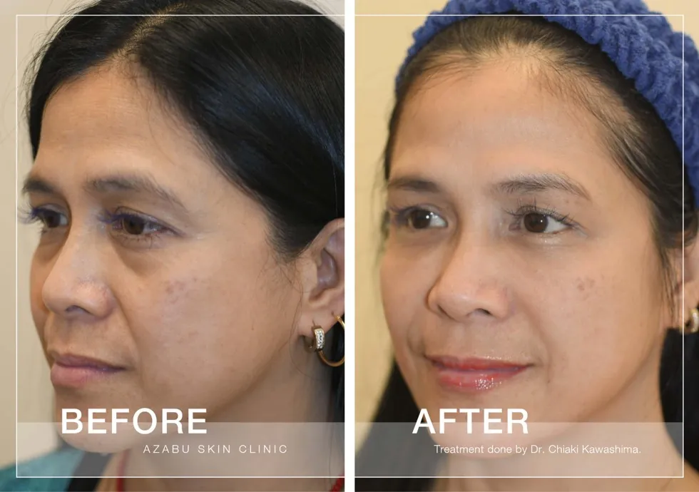 Before and after sagging skin treatment case from Azabu Skin Clinic