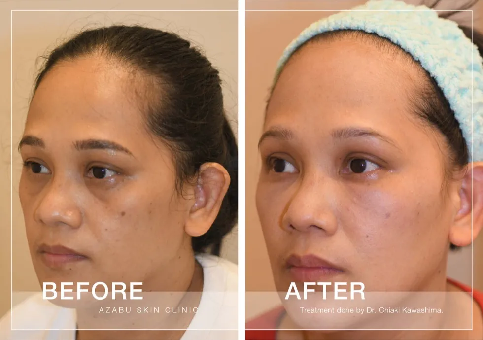 Before and after non-surgical facelift treatment case from Azabu Skin Clinic