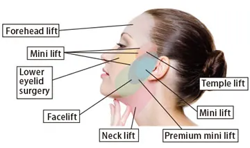 Facelift surgery for stronger face and neck sagging correction